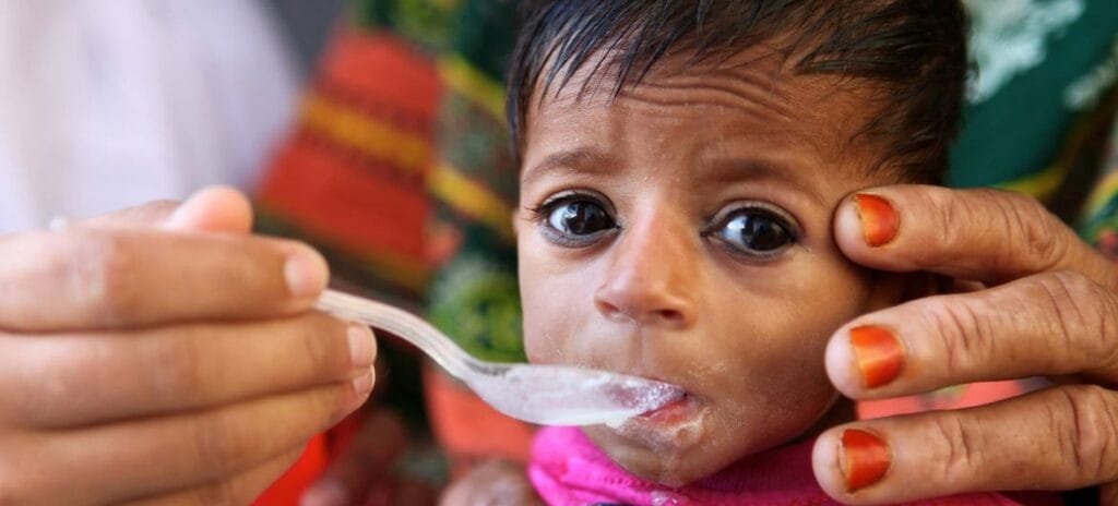 Une explosion catastrophique des taux de malnutrition sévère chez les enfants menace le monde, selon l’UNICEF