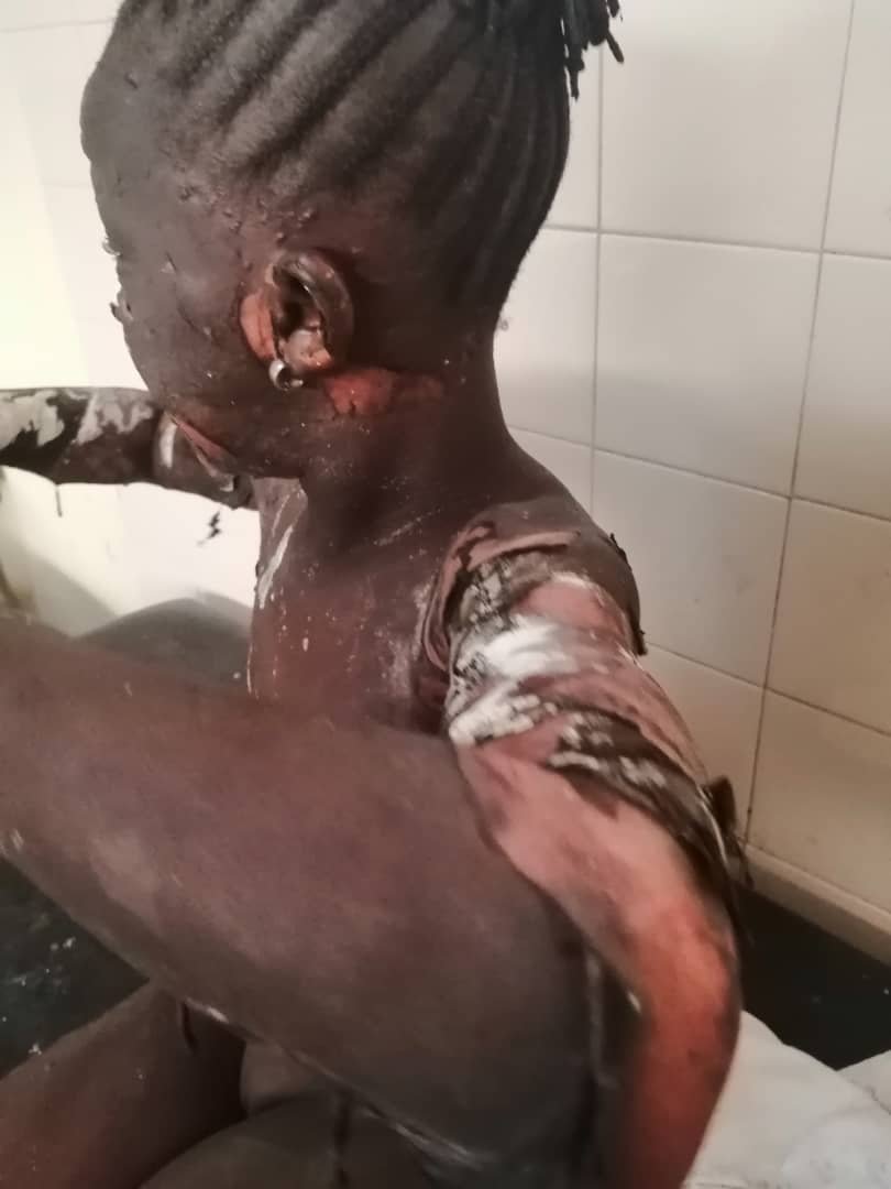 Abidjan: Début d’année dramatique pour une famille à Yopougon, 5 personnes brûlées par le gaz